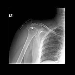 rotator-kaf-ameliyat